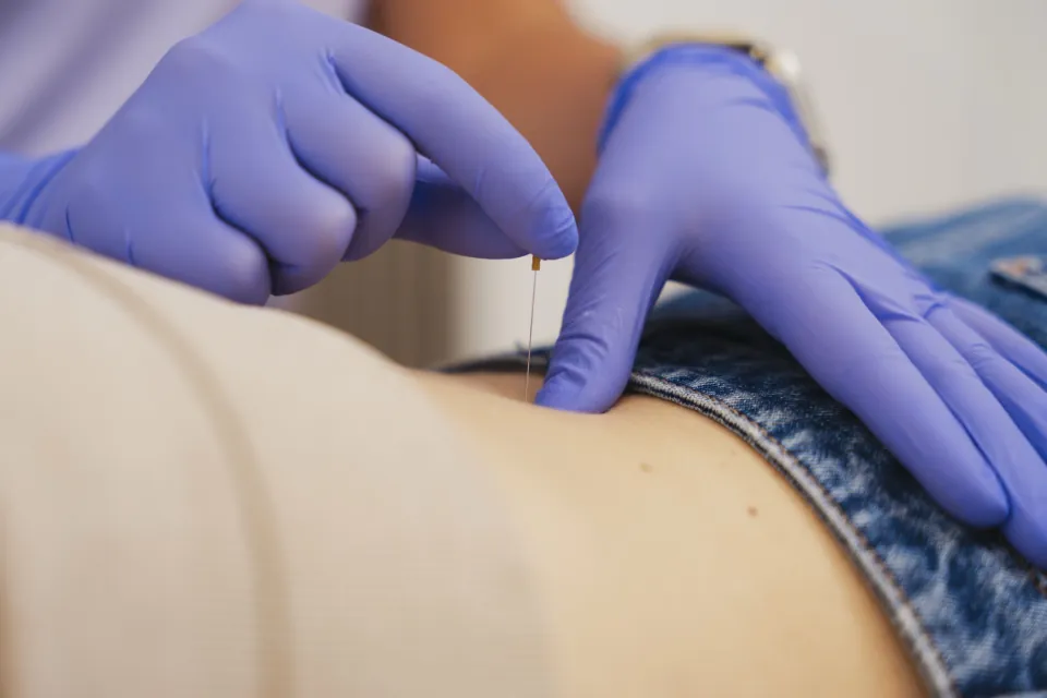 Dry needling